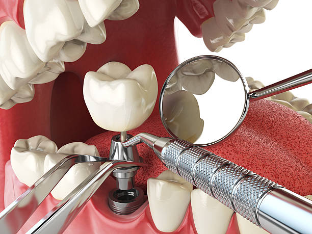 Best Urgent Care for Lost Fillings or Crowns in Clearwater, FL